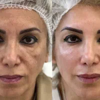 فیلرزیر چشم، زاویهفک، لیفت شقیقه، بوتاکس، لب نچرال|خدمات آرایشگری و زیبایی|مشهد, سرافرازان|دیوار