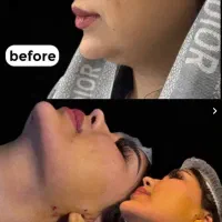 ساکشن غبغب وبلفاروپلاستی درکلینیک دکتربهنام روایی