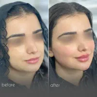کلینیک پزشک متخصص ژل لب روسی بوتاکس مزو فیلر زاویه
