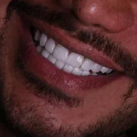لمینت کامپوزیت ایمپلنت ارتودنسی عصب کشی|خدمات آرایشگری و زیبایی|شیراز, قصرالدشت|دیوار