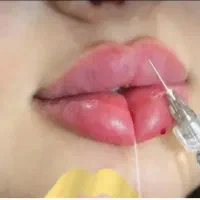 تزریق ژل و بوتاکس در چغادک اقتصادی