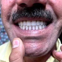 دست دندان مصنوعی و پروتز متحرک|خدمات آرایشگری و زیبایی|اصفهان, شهرک کاوه|دیوار