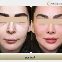 تور جراحی زیبایی قسطی|خدمات آرایشگری و زیبایی|کیش, |دیوار