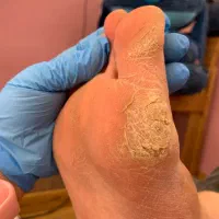 پدیکوریست و پودولژیست درمان میخچه و زگیل