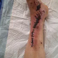 درمان نوین انواع زخم دیابتیک و بستر و جراحی و بخیه|خدمات آرایشگری و زیبایی|صومعهسرا, |دیوار