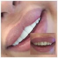 کامپوزیت دندان دندانپزشکی ((ویژه))