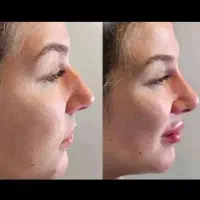 لیفت کامل بینی(اواتار) بدون جراحی به روش (NOA)|خدمات زیبایی و سلامت|مشهد, سناباد|دیوار
