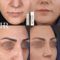 عمل بینی بلفارو پلاستی ساکشن غبغب ابدو ساکشن|خدمات آرایشگری و زیبایی|مشهد, ملک‌آباد|دیوار