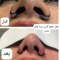 افتادگی پلکی زیبایی