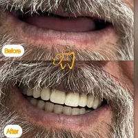 ساخت و تعمیر انواع دندان مصنوعی متحرک