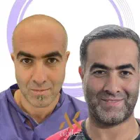 کاشت مو با بالاترین تراکم