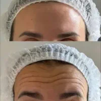تزریق بوتاکس تخصصی با مواد اورجینال ۶۵۰