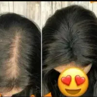 قطع مشکلات مربوط به ریزش مو