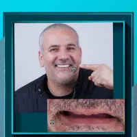 ایمپلنت دندانپزشکی ، رضایتمندی بالا ، تعرفه دولتی|خدمات زیبایی و سلامت|شیراز, ملاصدرا|دیوار