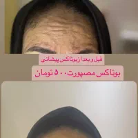 آف تزریق ژل وبوتاکس ومزوژل جوانساز|خدمات آرایشگری و زیبایی|آمل, |دیوار