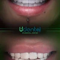 کاشت لبخند / کامپوزیت لمینیت|خدمات آرایشگری و زیبایی|تهران, قبا|دیوار