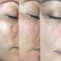 فیشال  پاکسازی پوست در کلینیک با افر ویژه|خدمات آرایشگری و زیبایی|تهران, حکمت|دیوار