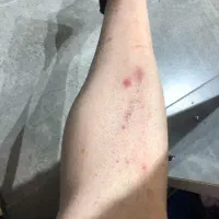 مشاوره درباره بیماری گال فقط در۳ روز با ایورمکتین6