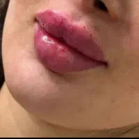 تخفیف،ژل وبوتاکس