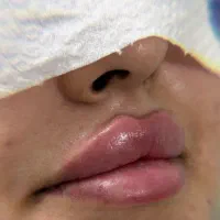 تزریق فیلر و بوتاکس با قیمت مناسب