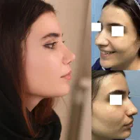 جراحی بینی،با دستگاه پیزوسرجری ،تخفیف 50درصد
