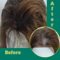 میکرواسکالپ رشد مجدد مو|خدمات آرایشگری و زیبایی|رشت, بوسار|دیوار