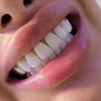 کامپوزیت دندان دندانپزشکی|خدمات آرایشگری و زیبایی|تهران, ستارخان|دیوار