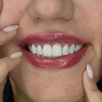 کامپوزیت و لمینت دندان با ضمانت و اقساط بدون سود|خدمات آرایشگری و زیبایی|تهران, امیرآباد|دیوار