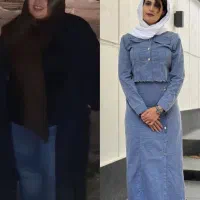 لاغری با بوتاکس معده