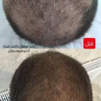 کاشت مو وزیبایی بدن اقساطی|خدمات آرایشگری و زیبایی|تبریز, |دیوار