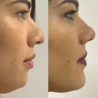 بدون عمل بینی تو خوش فرم کن
