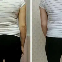 لاغری موضعی بادستگاه،مزوتراپی چربی سوز،رژیم درمانی