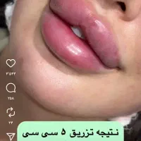 ژل ، بوتاکس ، چربی ، فیلر|خدمات آرایشگری و زیبایی|کرمانشاه, |دیوار