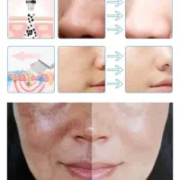 فشیال پاک سازی پوست فارسان|خدمات آرایشگری و زیبایی|فارسان, |دیوار