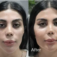 تزریق چربی|خدمات آرایشگری و زیبایی|تهران, تهرانسر مرکزی|دیوار