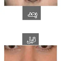 لوسیون لیفت وکوچیک کننده بینی تضمینی وبدون عوارض|آرایشی، بهداشتی، درمانی|کرمانشاه, |دیوار