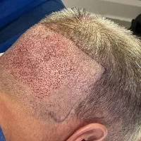 استخدام تکنسین کاشت مو و ابرو