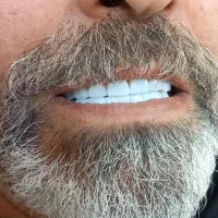 جشنواره خدمات زیبایی دندان با افر 60٪ از دست ندید|خدمات آرایشگری و زیبایی|بابل, |دیوار