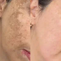 میخوای ۳روزه صورتت و بدنت سفید برفی شه ای کرم بزن|خدمات آرایشگری و زیبایی|ایذه, |دیوار