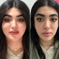 جشنواره ۳ روزه بوتاکس ۵۵۰ و فیلر ۸۰۰