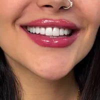 کامپوزیت دندان