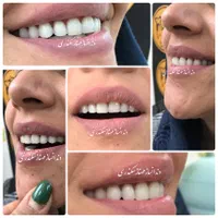 دندانسازی سکندری کرمان دندان ایتالیایی لثه نرم|خدمات آرایشگری و زیبایی|کرمان, |دیوار