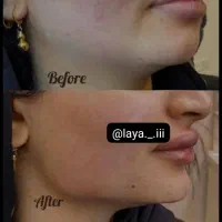 تزریقات ژل و بوتاکس