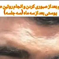 جای جوش و ابله و لک جوش|خدمات آرایشگری و زیبایی|دورود, |دیوار