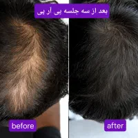 پی آر پی هیرفیلر ریزش مو PRP پی آر اف توسط پزشک