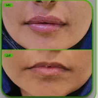 ژل لب،چونه ،آنزیم ،زاویه ،بوتاکس|خدمات آرایشگری و زیبایی|قم, تولید دارو و یخچال|دیوار