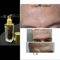 درمان چین وچروک صورت ولک صورت بصورت تضمین|آرایشی، بهداشتی، درمانی|اهواز, زرگان|دیوار
