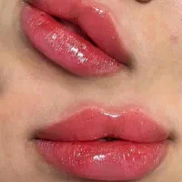 جشنواره تخفیفات ویژه تزریق فیلر و بوتاکس
