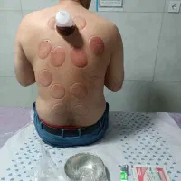 حجامت و بادکش درمانی (تحت نظر پزشک)