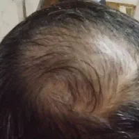 رویش مو بدون کاشت مو